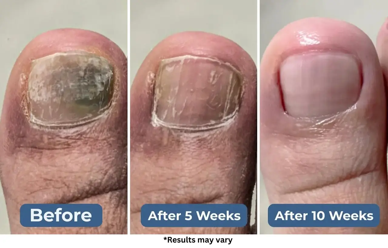 Case #3: An Athlete Crippled by Toenail Fungus Is Running Again After 10 Weeks